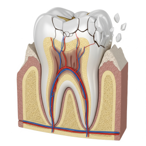 tooth whitening